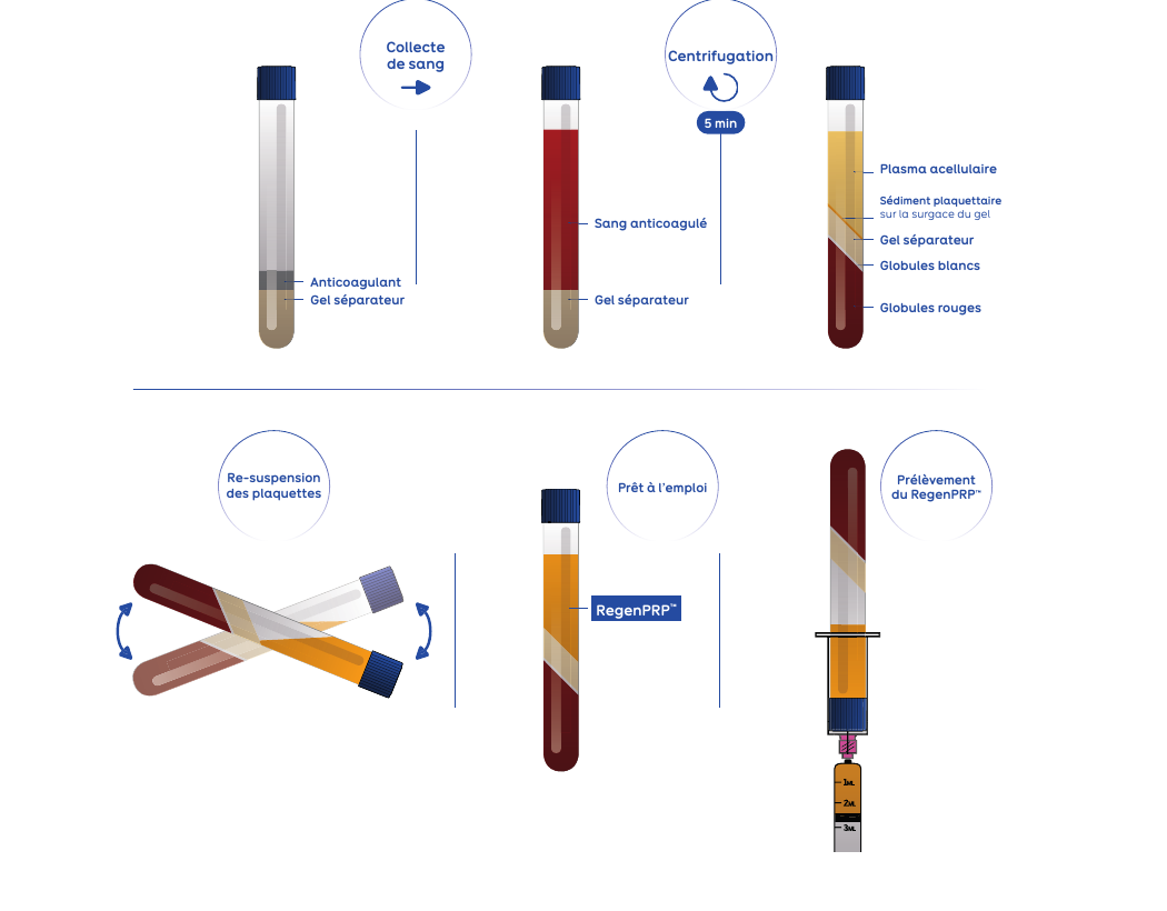 Schéma de préparation du RegenPRP™ avec la technologie Regen BCT : collecte de sang, centrifugation, re-suspension des plaquettes, préparation prête à l’emploi et prélèvement du RegenPRP™